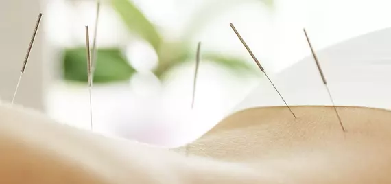 acupuncture needles in someone's back